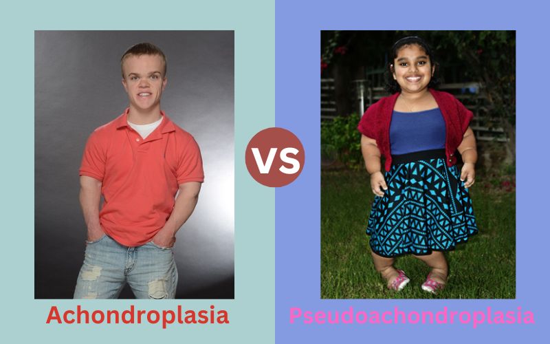 Best 10 Facts about Achondroplasia and Pseudoachondroplasia