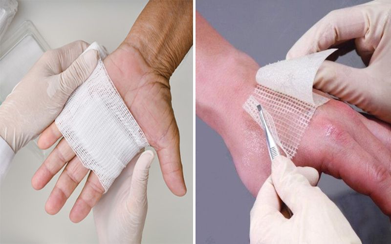 10 Best Difference Between Bactigras and Jelonet