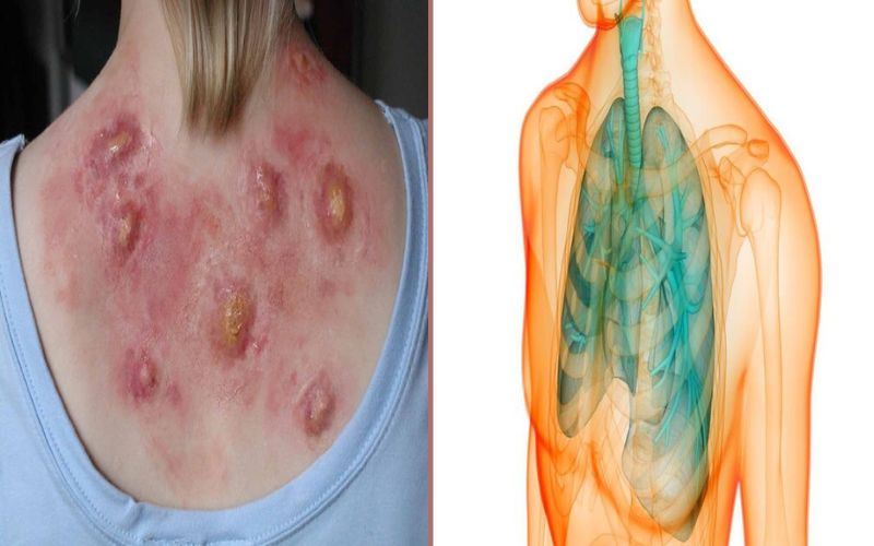 Difference Between Bubonic and Pneumonic Plague