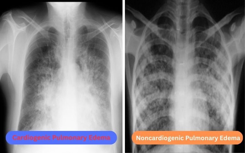 Cardiogenic and Noncardiogenic Pulmonary Edema – Best 11 Difference