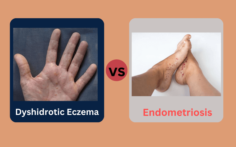Difference Between Dyshidrotic Eczema and Herpetic Whitlow