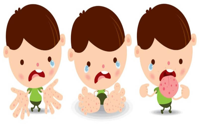 Difference between HFMD and Herpangina