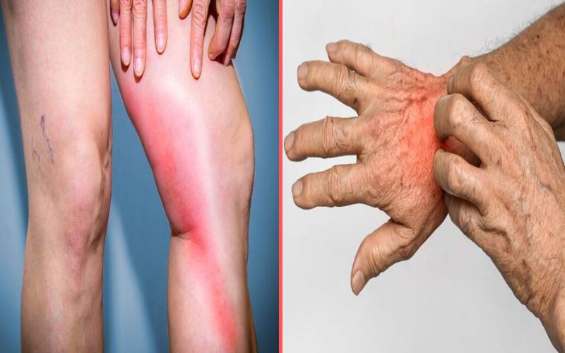 Difference Between Phlebitis and Thrombophlebitis