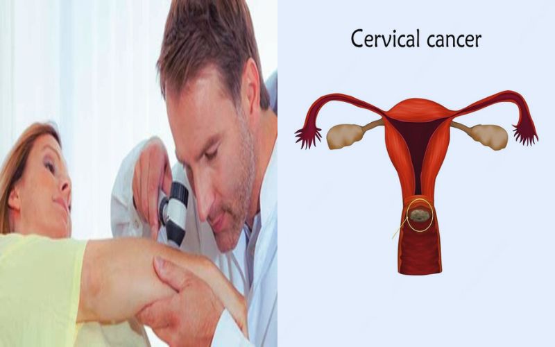 Best 11 Difference Between Squamous Cell Carcinoma and Adenocarcinoma Cervix