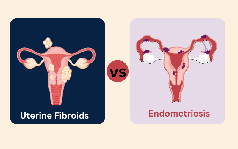 Top 10 Facts About Uterine Fibroids and Endometriosis